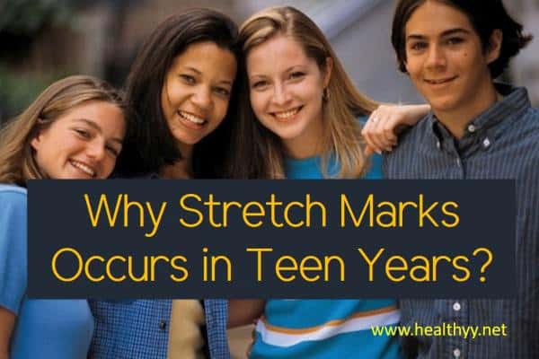 Why Stretch Marks Occurs in Teen Years