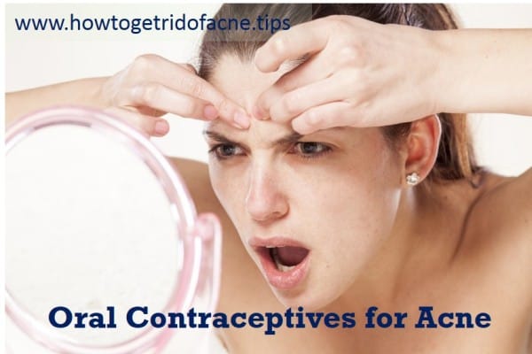 oral contraceptives for acne