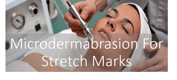 Microdermabrasion for stretch marks