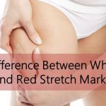 Difference Between White and Red Stretch Marks