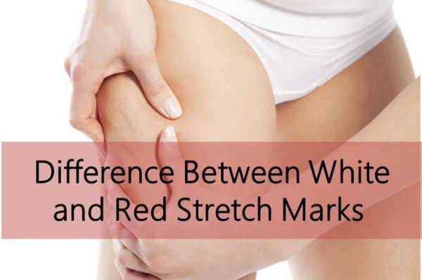 Difference Between White and Red Stretch Marks