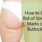 How to Get Ricd of Stretch Marks on Buttocks