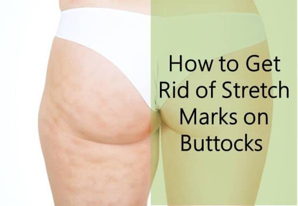 How to Get Ricd of Stretch Marks on Buttocks