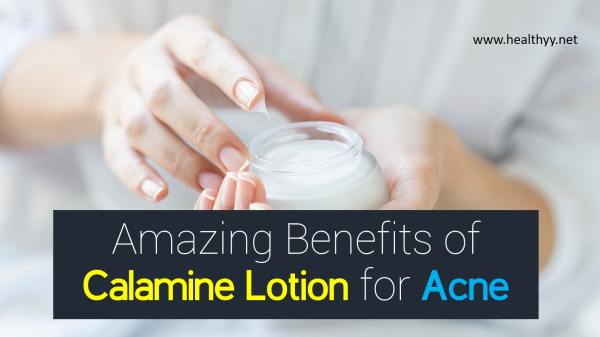 Amazing Benefits of Calamine Lotion for Acne