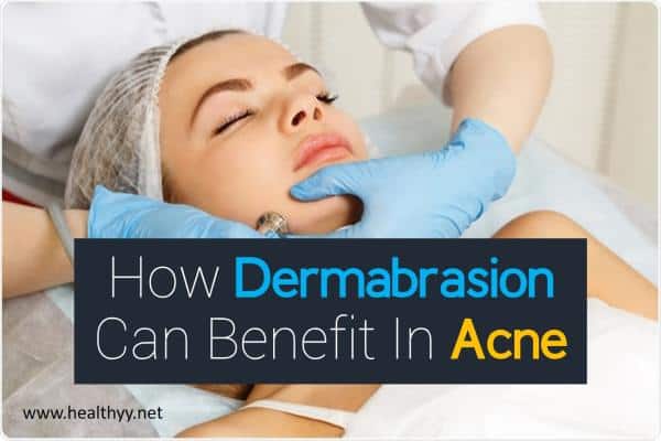 How Dermabrasion Can Benefit In Acne