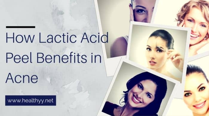 How Lactic Acid Peel Benefits in Acne