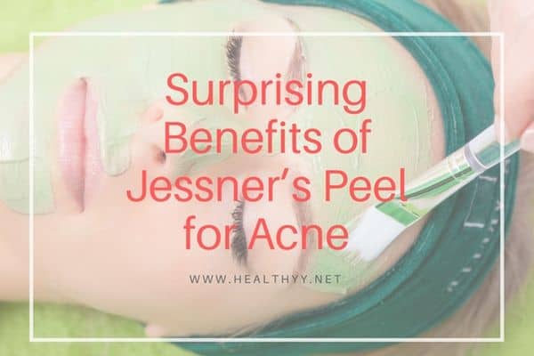 Surprising Benefits of Jessner’s Peel for Acne