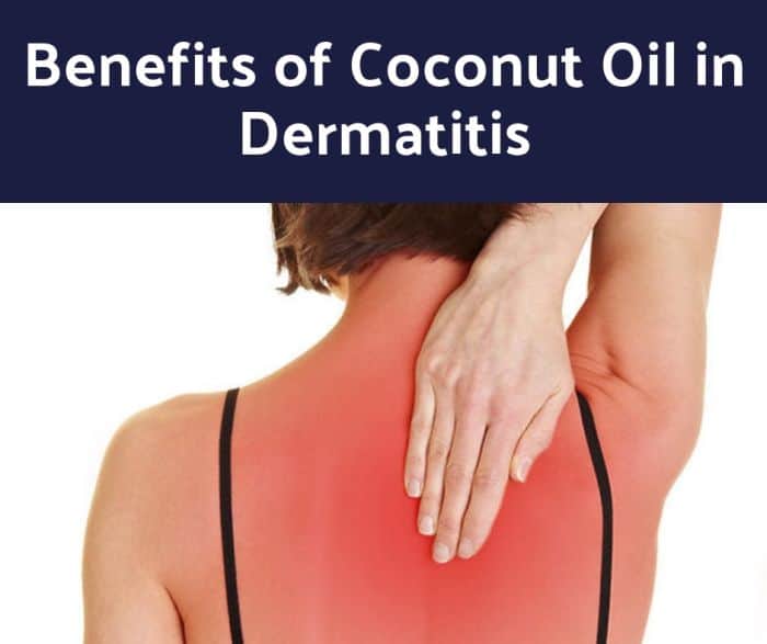 Benefits of Coconut Oil in Dermatitis